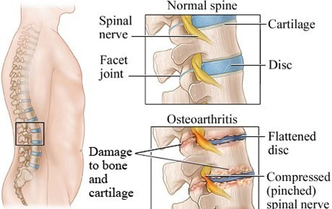 A különbség az egészséges lemez és az osteochondrosissal rendelkező korong között