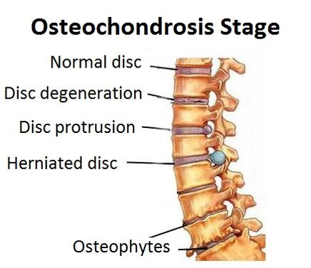 Osteokondrózis szakaszai